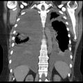 Cardiogenic pulmonary edema (Radiopaedia 29213-29609 Coronal non-contrast 30).jpg