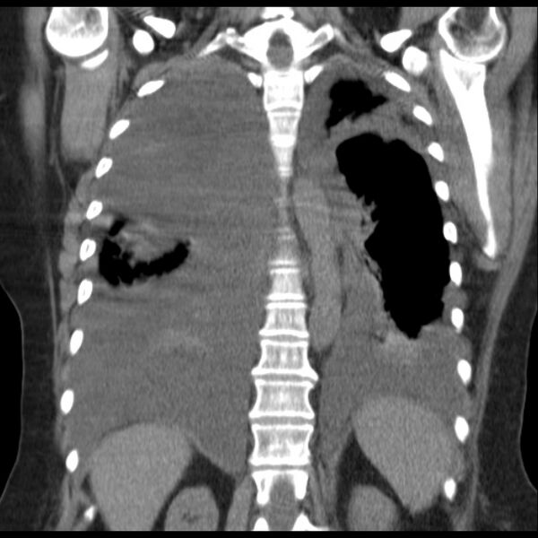 File:Cardiogenic pulmonary edema (Radiopaedia 29213-29609 Coronal non-contrast 30).jpg