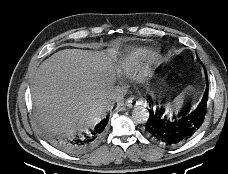 File:Cardiogenic pulmonary edema (Radiopaedia 68180-77678 Axial non-contrast 45).jpg