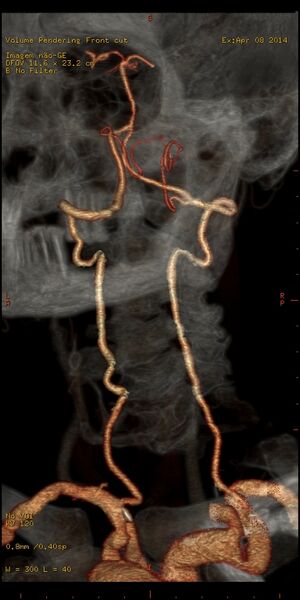 File:Carotid artery stenosis (Radiopaedia 28786-29086 B 7).jpg