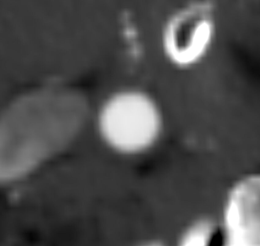 Carotid near-occlusion (Radiopaedia 85304-100887 M 22).jpg