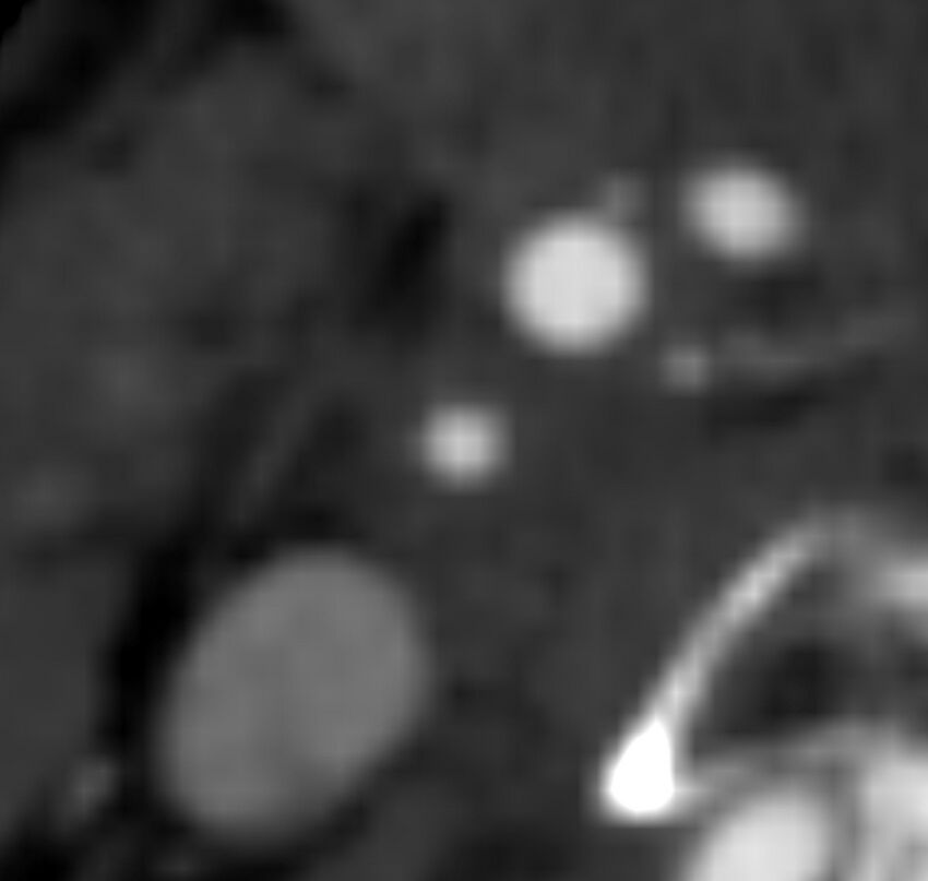 Carotid near-occlusion (Radiopaedia 85304-100887 M 86).jpg