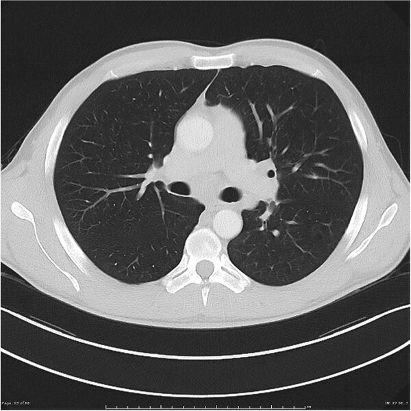 File:Cavitating lung cancer (Radiopaedia 25796-25945 Axial lung window 23).jpg