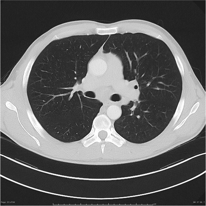 Cavitating lung cancer (Radiopaedia 25796-25945 Axial lung window 23).jpg
