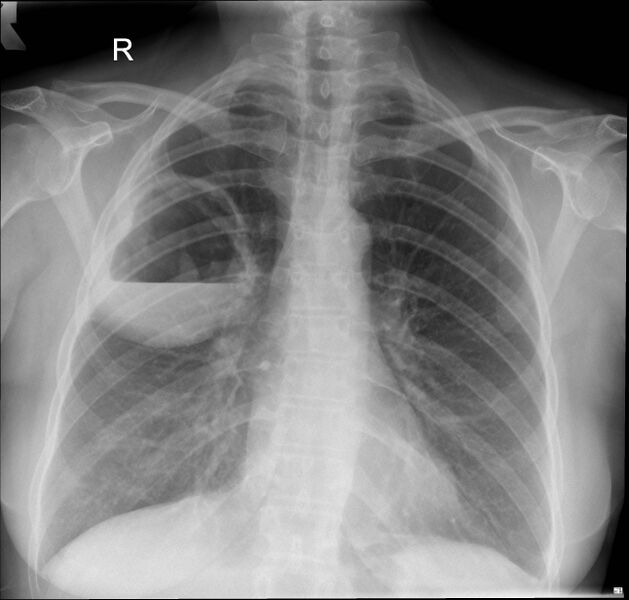 File:Cavitating lung lesion (Radiopaedia 30067).jpg