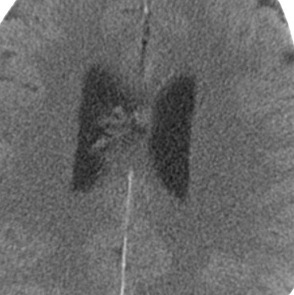 File:Central neurocytoma (Radiopaedia 68725-78432 C 3).jpg