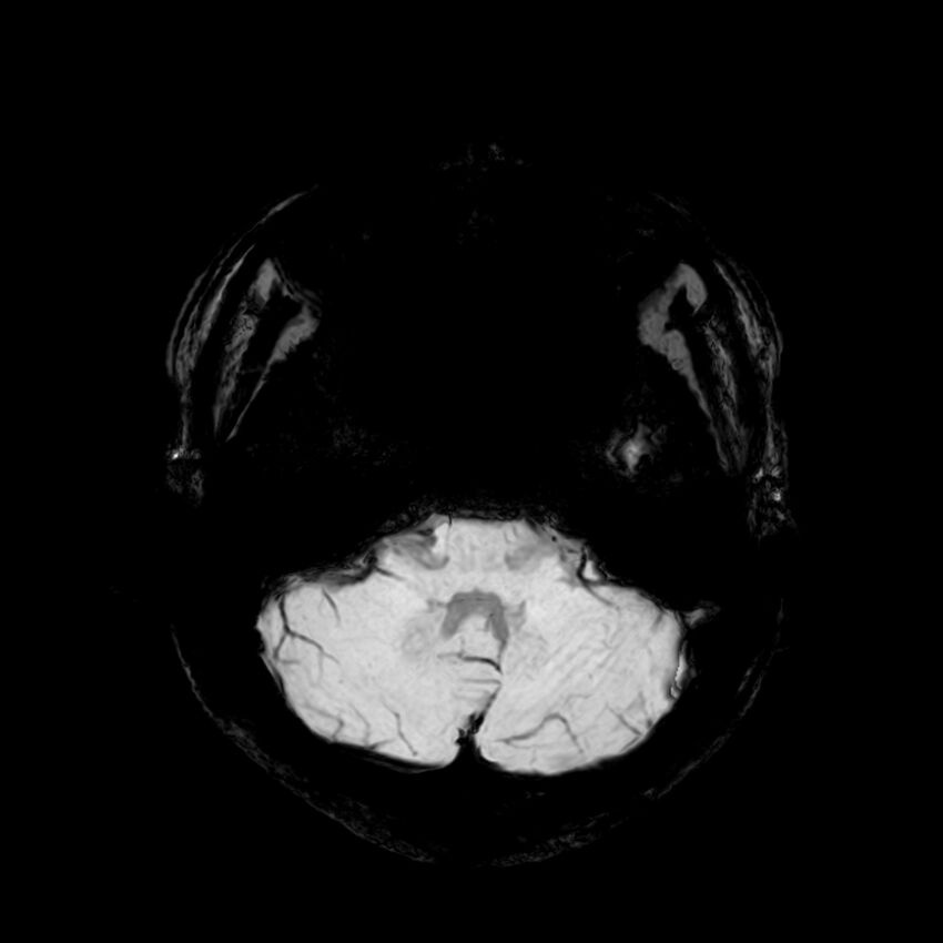 Central neurocytoma (Radiopaedia 79320-92380 Axial SWI 28).jpg