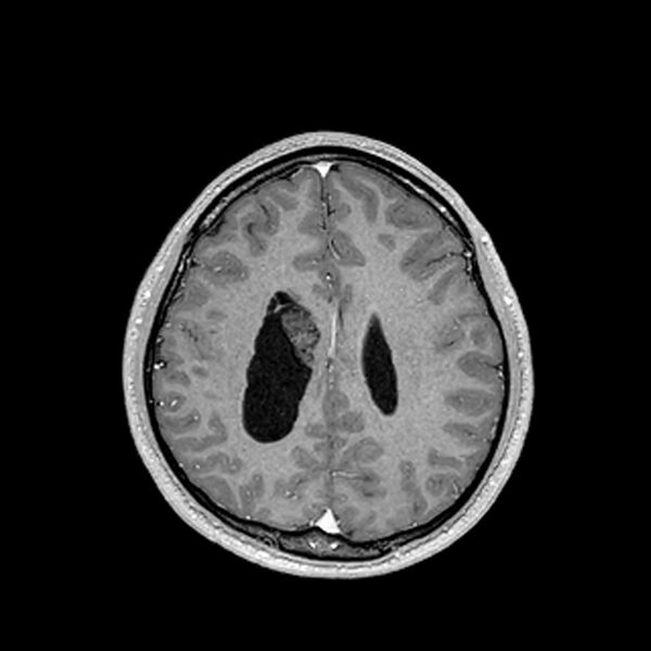 File:Central neurocytoma (Radiopaedia 79320-92380 Axial T1 C+ 167).jpg