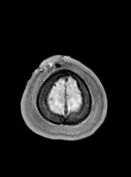 File:Central neurocytoma (Radiopaedia 79320-92381 Axial T1 52).jpg