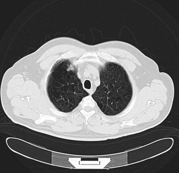 File:Centrilobular pulmonary emphysema (Radiopaedia 26808-26971 C 7).jpg
