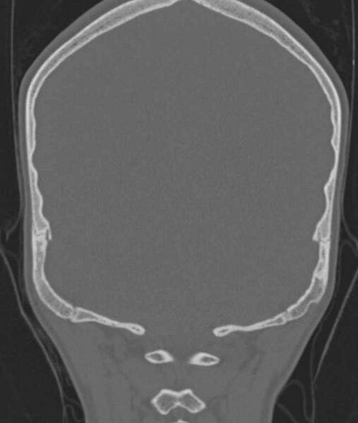 File:Cerebellar abscess (Radiopaedia 73727-84527 Coronal bone window 14).jpg