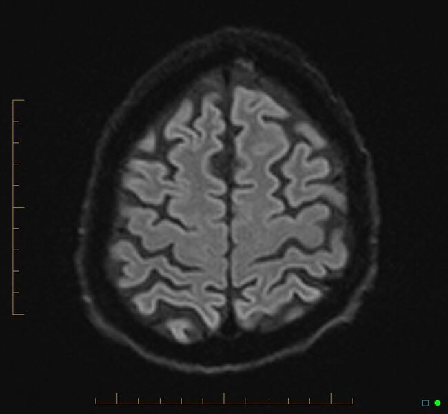 File:Cerebellar gangliocytoma (Radiopaedia 65377-74422 Axial DWI 33).jpg