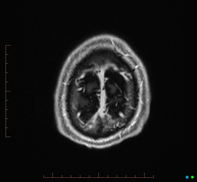 File:Cerebellar gangliocytoma (Radiopaedia 65377-74422 Axial T1 C+ 136).jpg