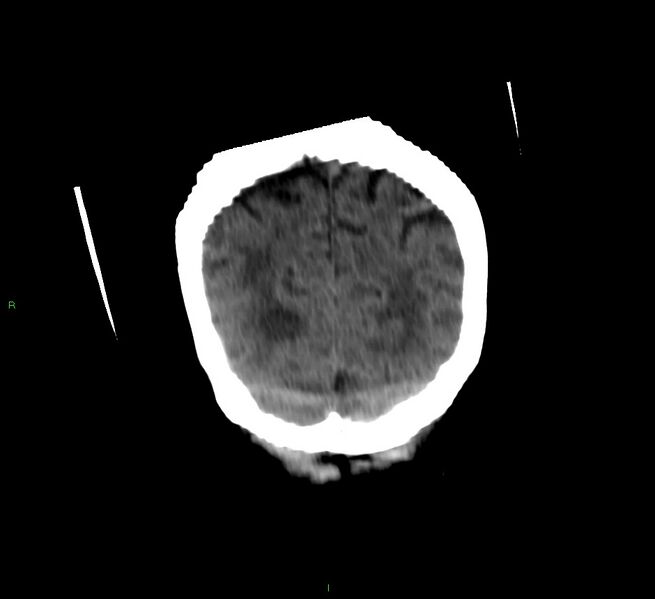 File:Cerebellar hemorrhage (Radiopaedia 58792-66026 Coronal non-contrast 14).jpg