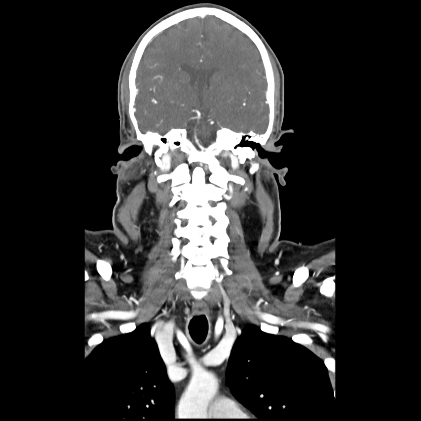 Cerebellar infarct due to vertebral artery dissection with posterior fossa decompression (Radiopaedia 82779-97029 D 31).png