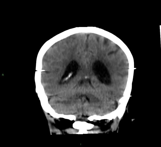 File:Cerebral amyloid angiopathy-associated lobar intracerebral hemorrhage (Radiopaedia 58377-65514 Coronal non-contrast 23).jpg