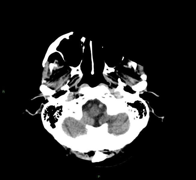 File:Cerebral amyloid angiopathy-associated lobar intracerebral hemorrhage (Radiopaedia 58530-65688 Axial non-contrast 44).jpg