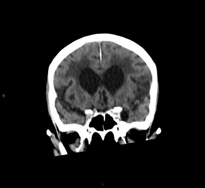 File:Cerebral amyloid angiopathy-associated lobar intracerebral hemorrhage (Radiopaedia 58530-65688 Coronal non-contrast 45).jpg