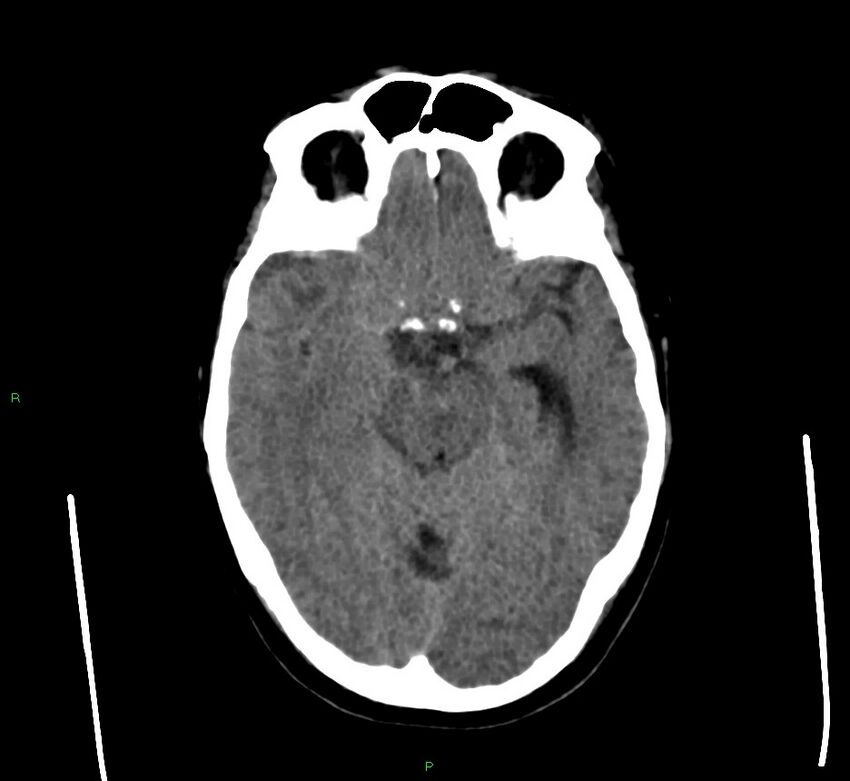 Cerebral amyloid angiopathy-associated lobar intracerebral hemorrhage (Radiopaedia 58560-65723 Axial non-contrast 34).jpg