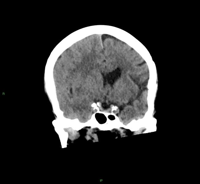 File:Cerebral amyloid angiopathy-associated lobar intracerebral hemorrhage (Radiopaedia 58563-65727 Coronal non-contrast 42).jpg