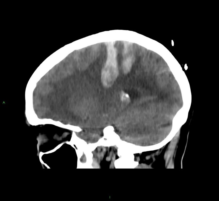 Cerebral amyloid angiopathy-associated lobar intracerebral hemorrhage (Radiopaedia 58566-65730 C 18).jpg