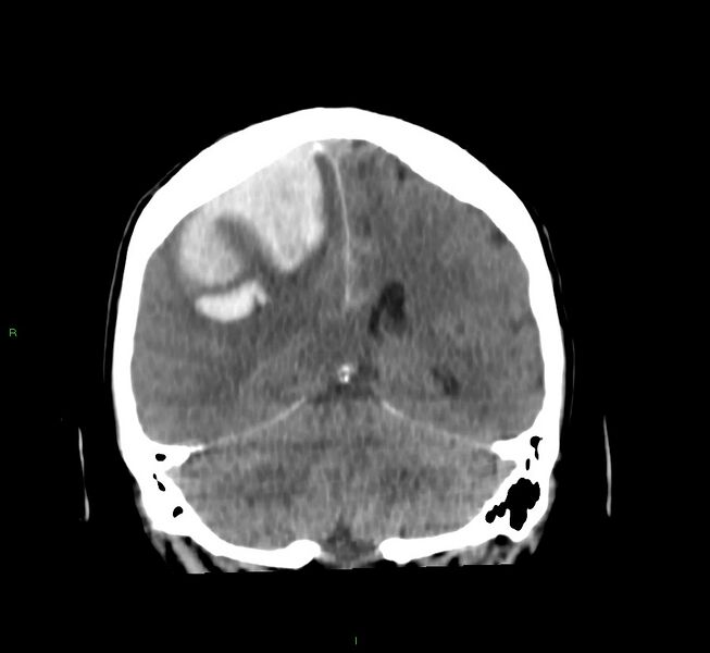File:Cerebral amyloid angiopathy-associated lobar intracerebral hemorrhage (Radiopaedia 58756-65977 Coronal non-contrast 26).jpg