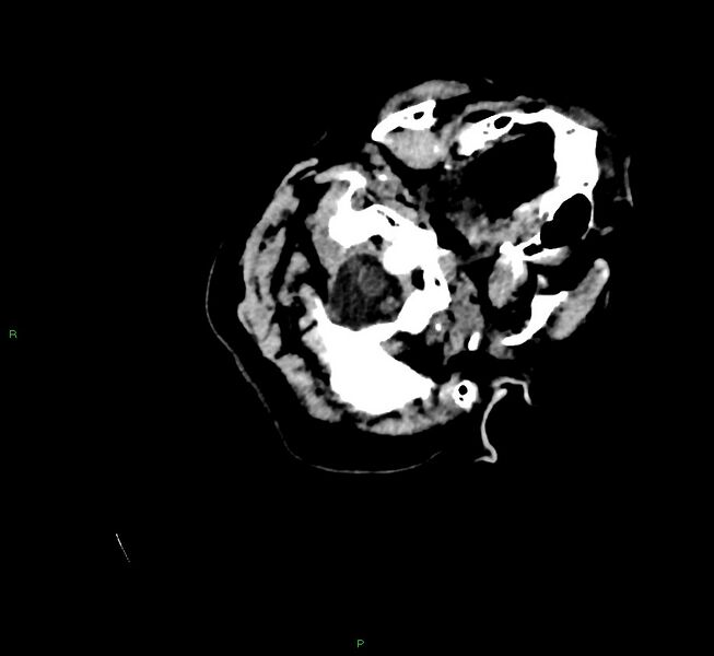 File:Cerebral amyloid angiopathy-associated lobar intracerebral hemorrhage (Radiopaedia 58757-65979 Axial non-contrast 10).jpg