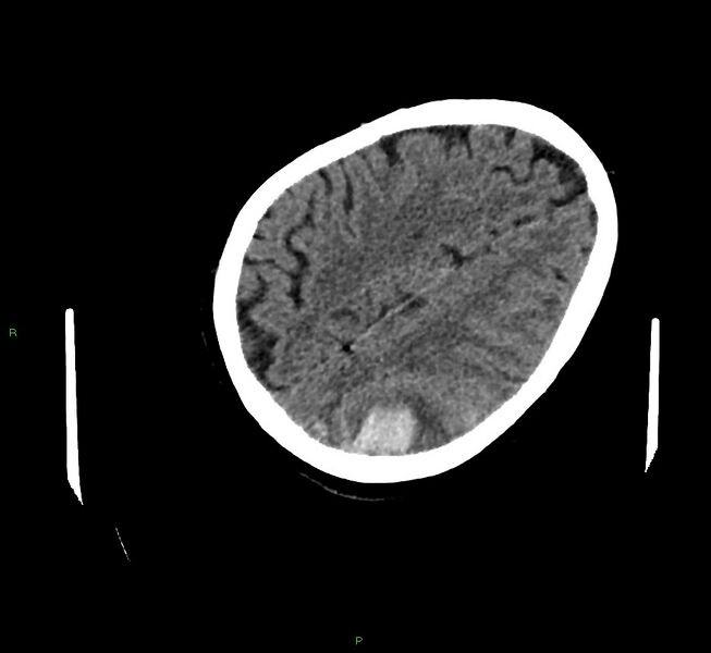 File:Cerebral amyloid angiopathy-associated lobar intracerebral hemorrhage (Radiopaedia 58757-65979 Axial non-contrast 104).jpg