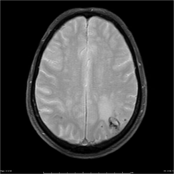 File:Cerebral amyloid angiopathy (Radiopaedia 4561-6683 Axial Gradient Echo 6).jpg