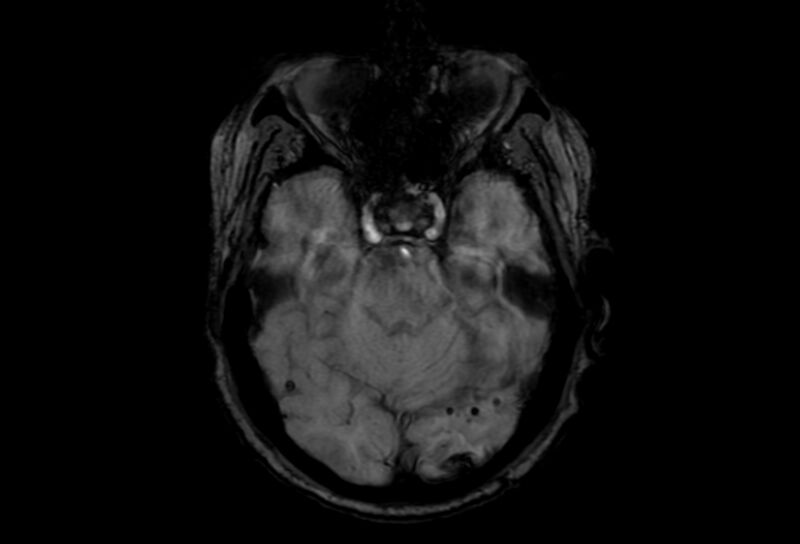 File:Cerebral amyloid angiopathy (Radiopaedia 86671-102792 Axial Gradient Echo 39).jpg