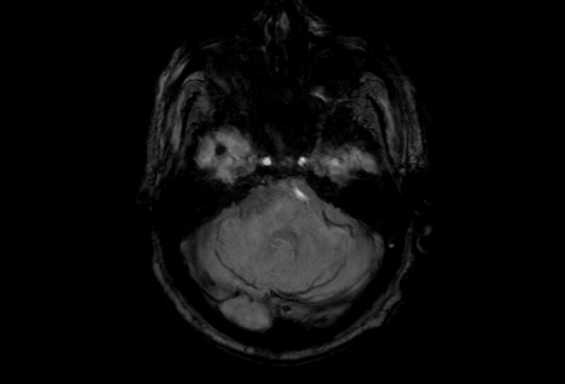 File:Cerebral amyloid angiopathy (Radiopaedia 86671-102792 Axial Gradient Echo 43).jpg
