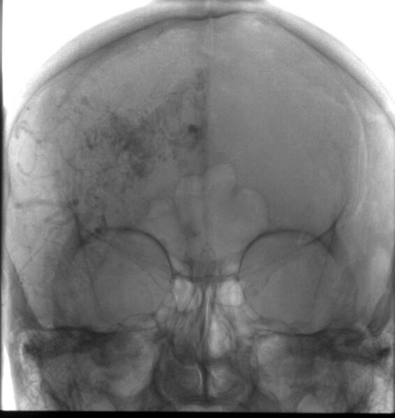 File:Cerebral arteriovenous malformation (Radiopaedia 10989-11408 A 1).jpg