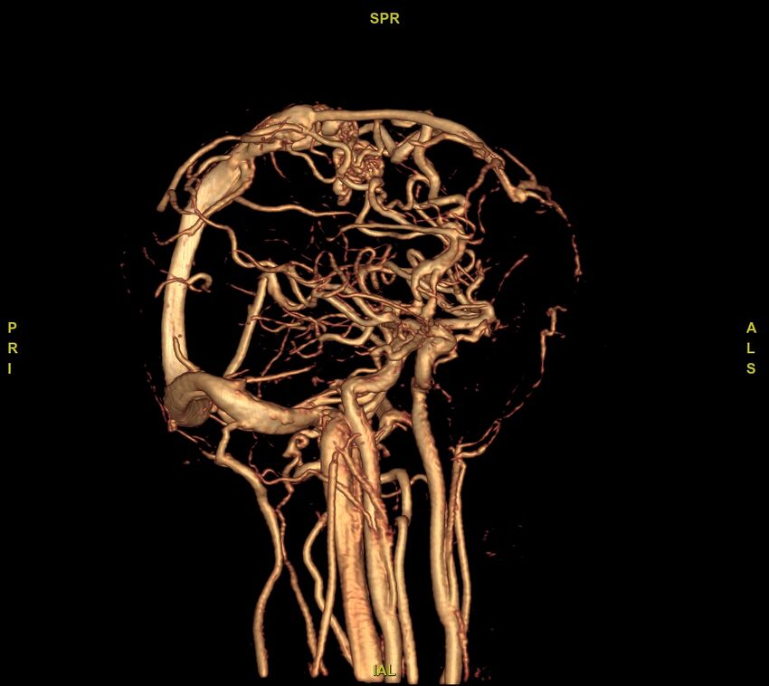 Cerebral arteriovenous malformation (Radiopaedia 61964-70029 VRT 32).jpg