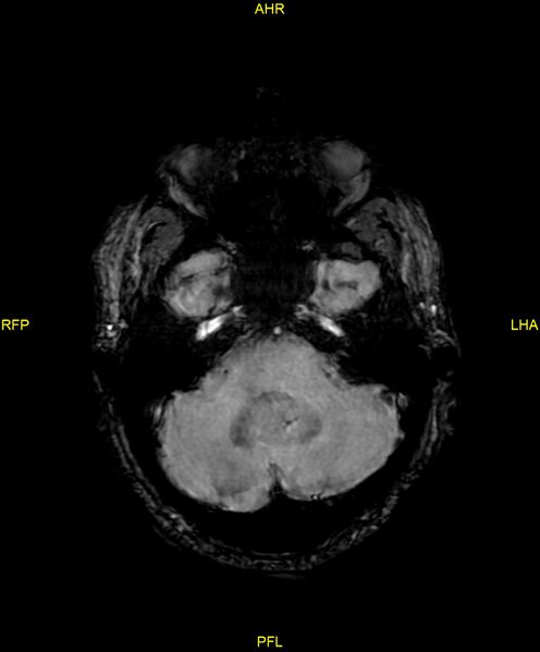 File:Cerebral autosomal dominant arteriopathy with subcortical infarcts and leukoencephalopathy (CADASIL) (Radiopaedia 86108-102054 Axial SWI 28).jpg