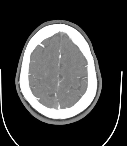 File:Cerebral dural venous sinus thrombosis (Radiopaedia 86514-102576 A 78).jpg