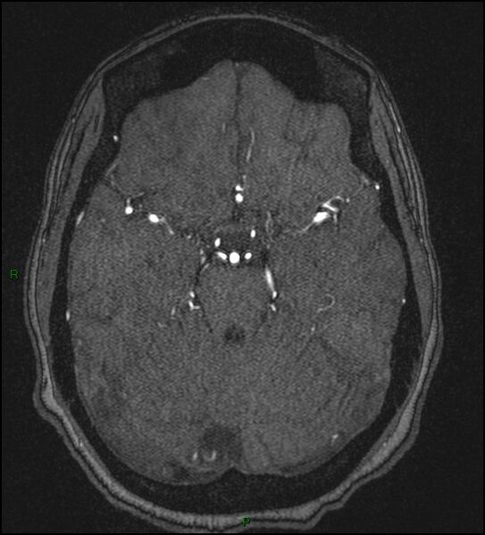 File:Cerebral fat embolism (Radiopaedia 35022-36525 Axial TOF 73).jpg