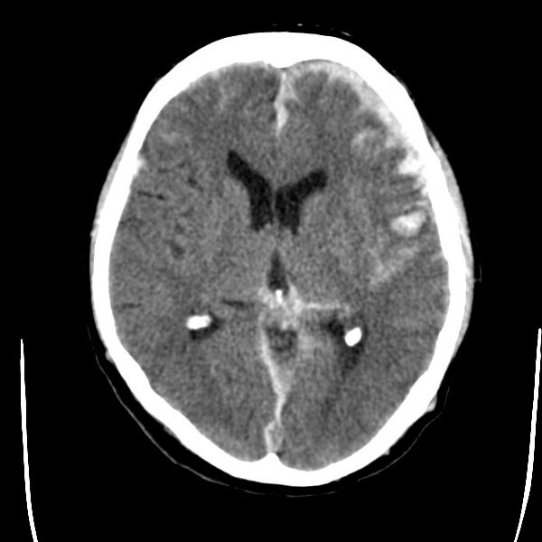File:Cerebral hemorrhagic contusions (Radiopaedia 23145-23188 Axial non-contrast 20).jpg