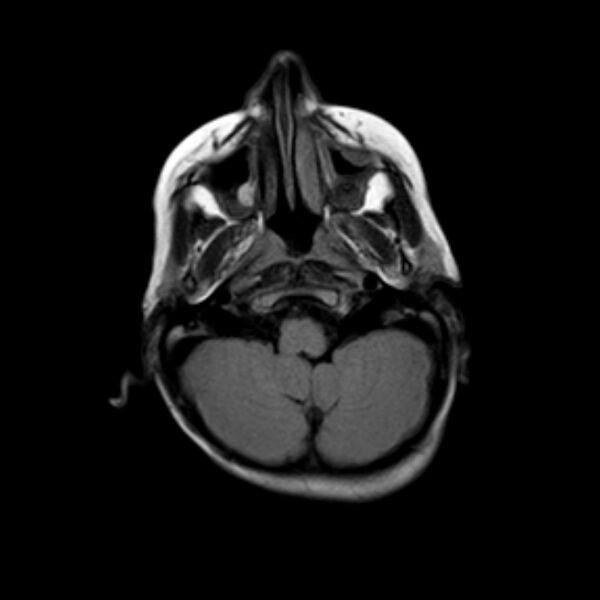 File:Cerebral tuberculoma (Radiopaedia 41152-43932 Axial FLAIR 3).jpg