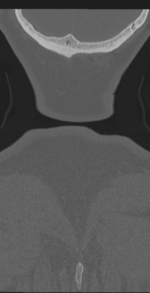 File:Cervical canal stenosis due to ossification of the posterior longitudinal ligament (Radiopaedia 47260-51823 Coronal bone window 77).png