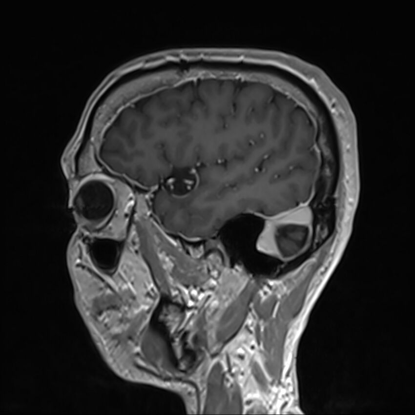 Cervical dural CSF leak on MRI and CT treated by blood patch (Radiopaedia 49748-54995 G 13).jpg