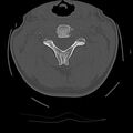 Cervical flexion teardrop fracture with cord hemorrhage (Radiopaedia 32497-33454 Axial bone window 29).jpg