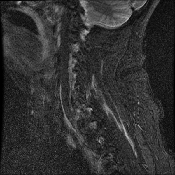 File:Cervical fracture and dislocation with locked facet (Radiopaedia 31837-32781 Sagittal STIR 14).jpg