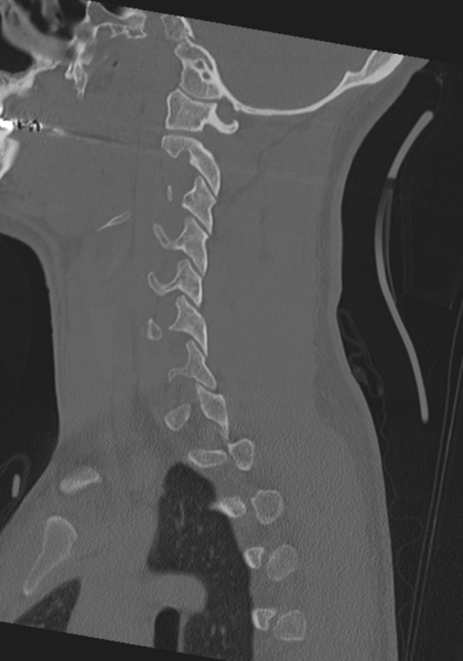 File:Cervical intercalary bone (Radiopaedia 35211-36748 Sagittal bone window 54).png