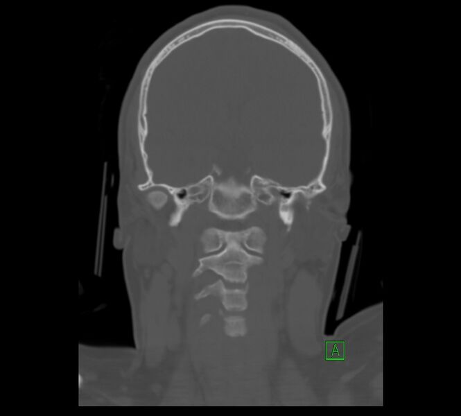 File:Cervical spine fracture - hyperflexion injury (Radiopaedia 66184-75364 Coronal bone window 2).jpg