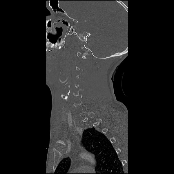 File:Cervical spine fractures with vertebral artery dissection (Radiopaedia 32135-33078 Sagittal bone window 34).jpg