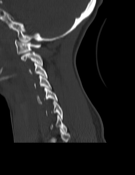 File:Cervical spine posterior ligamentous complex rupture (Radiopaedia 63486-72101 Sagittal bone window 20).jpg