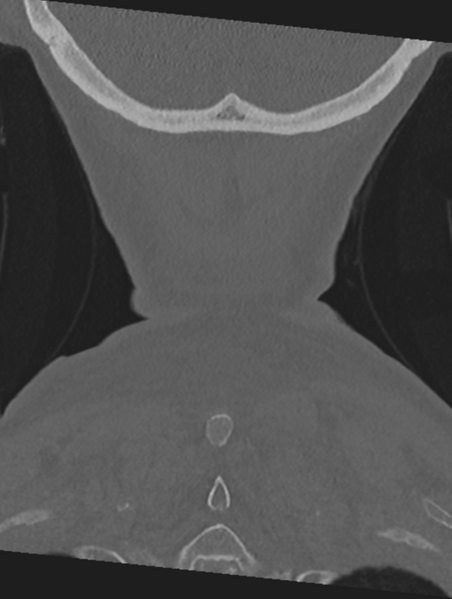 File:Cervical spondylolysis (Radiopaedia 49616-54811 Coronal bone window 61).png