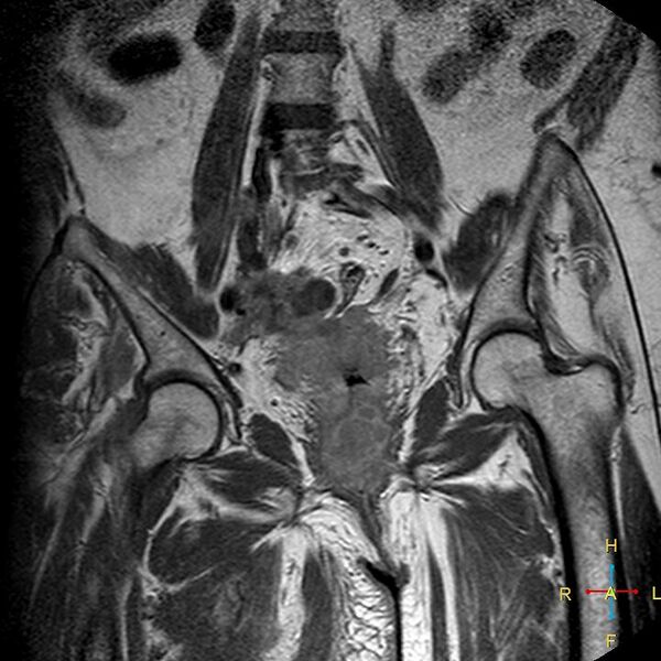 File:Cervical stump squamous cell carcinoma (Radiopaedia 48049-52858 Coronal T1 C+ 7).jpg