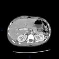 Chance fracture with duodenal and pancreatic lacerations (Radiopaedia 43477-46864 A 2).jpg