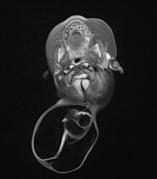 File:Chiari III malformation with occipital encephalocele (Radiopaedia 79446-92559 Axial FLAIR 9).jpg